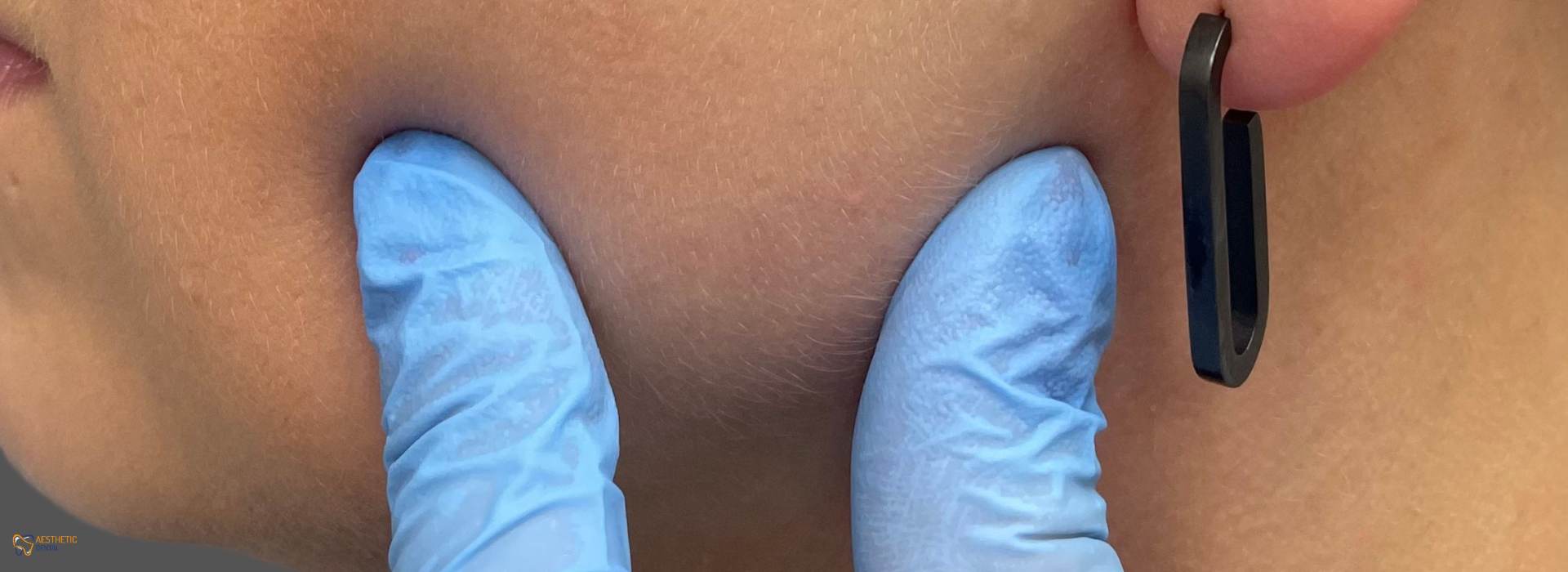 Leczenie bruksizmu botoksem Piotrk&oacute;w Trybunalski botox żwacze