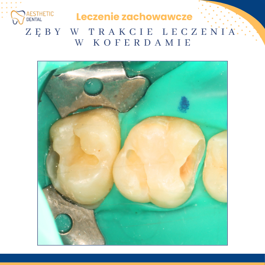 Leczenie zachowawcze w koferdamie Piotkrów