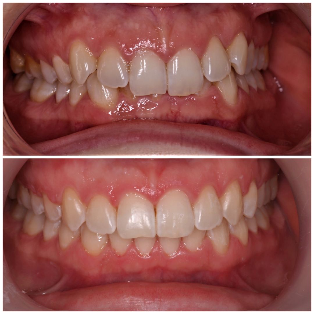 metamorfoza leczenie ortodontyczne w Piotrkowie Trybunalskim