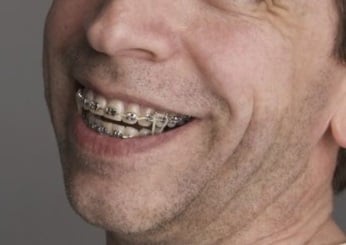 leczenie ortodontyczne w Piotrkowie Trybunalskim stały aparat ortodontyczny