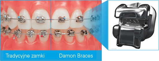 aparat samoligaturujący Damon zamki metalowe leczenie ortodontyczne Piotrków Trybunalski