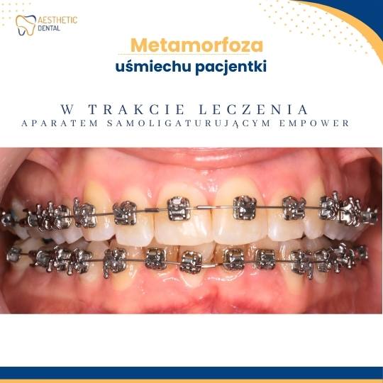 Aparat metalowy stały Empower
