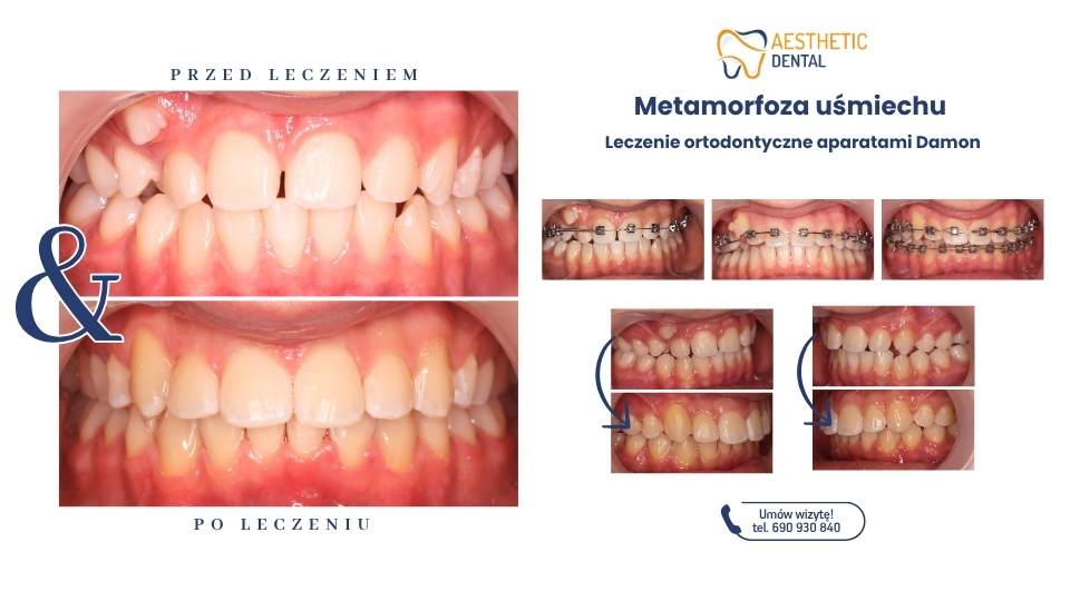 Leczenie ortodontyczne w Piotrkowie Trybunalskim gdzie warto umówić się na wizytę do ortodonty