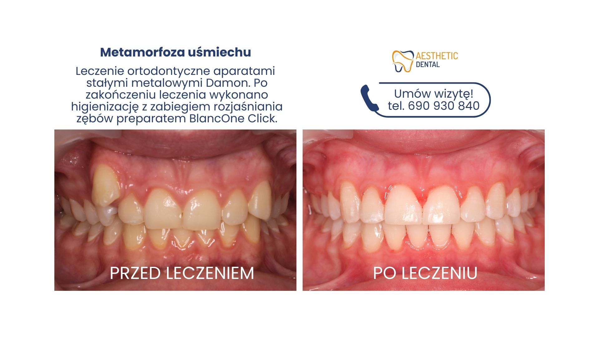 Kieł poza łukiem po leczeniu ortodontycznym efekt noszenia aparatu