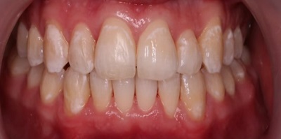 leczenie ortodontyczne nakładkami w Piotrkowie Trybunalskim metamorfoza