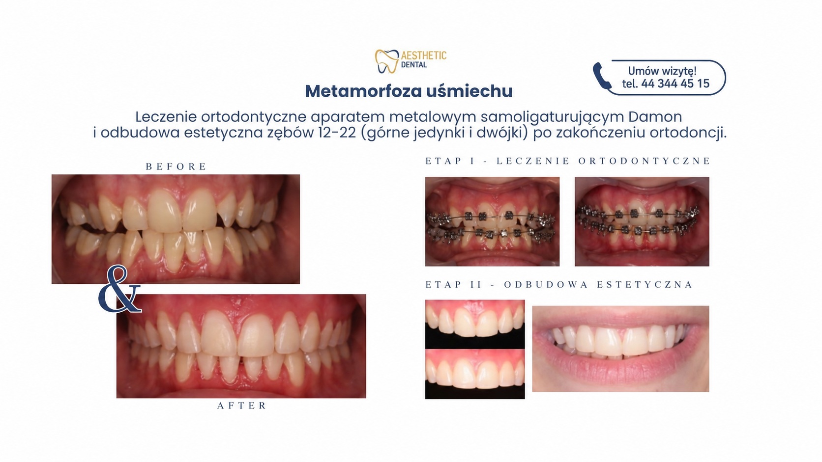 Bonding po leczeniu ortodontycznym czy warto? Efekt leczenia.