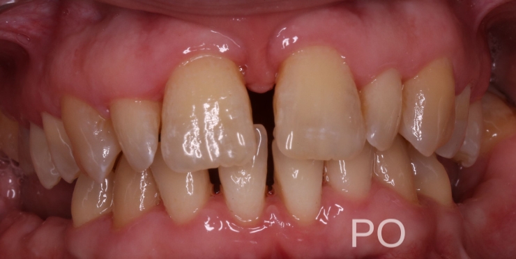 Efekt skalingu i piaskowania wykonanego w przychodnie Aesthetic Dental w Piotrkowie Trybunalskim