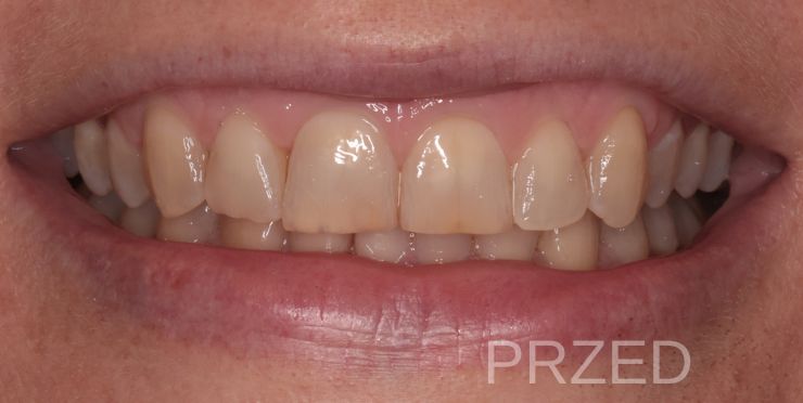 Zęby przed zabiegiem bondingu Magdalena Stepień dentysta Piotrków Trybunalski