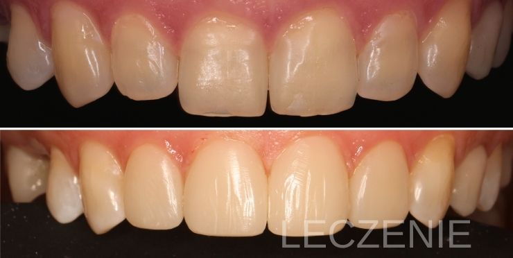 Odbudowa estetyczna zębów bonding po ortodoncji Piotrków Trybunalski Magdalena Stępień dentysta