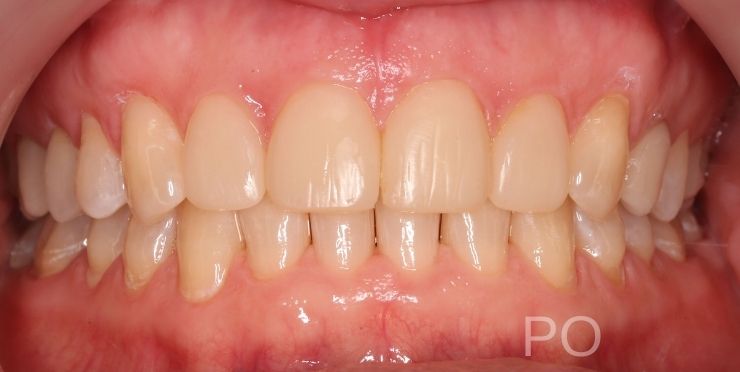 Metamorfoza uśmiechu efekt po kompleksowym leczeniu stomatologicznym Piotrków Trybunalski dentysta