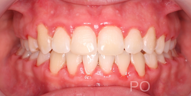 leczenie ortodontyczne w Piotrkowie Trybunalskim metamorfoza