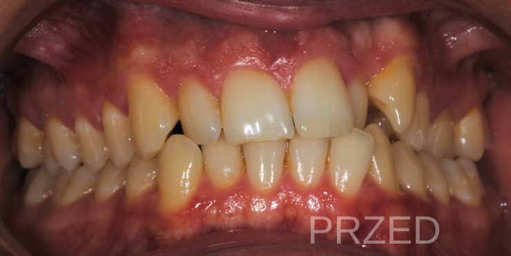 leczenie ortodontyczne w Piotrkowie Trybunalskim metamorfoza