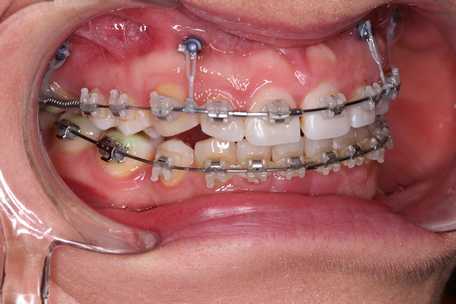 Mini implanty stosowane przy zamykaniu przestrzeni po brakujących zębach podczas leczenia ortodontycznego w Aesthetic Dental