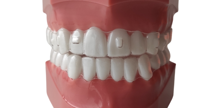 Nakładki ortodontyczne Spark używane do leczenia wad zgryzu przez ortodontę w Piotrkowie Trybunalskim w Aesthetic Dental