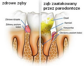 Zęby zdrowe i zęby z paradontozą leczenie paradontozy w Piotrkowie Trybunalskim periodentolog