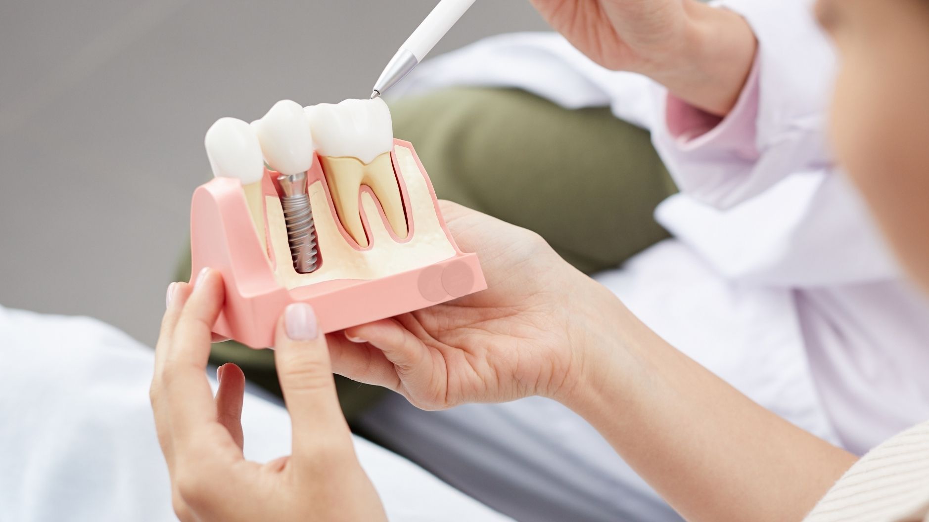 jak wygląda model implantu i korony na implancie