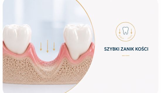 Szybki zanik kości uniknij tego dzięki implantom zębowym