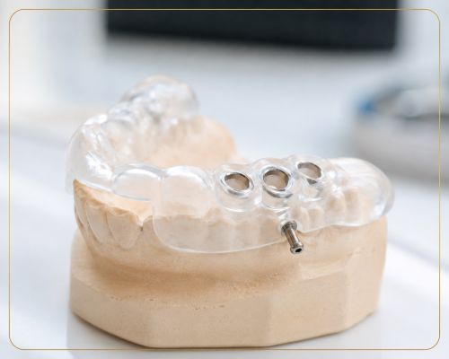 Szablon implantologiczny to najlepszy spos&oacute;b na bezpieczny i komfortowy wszczep implantu zębowego